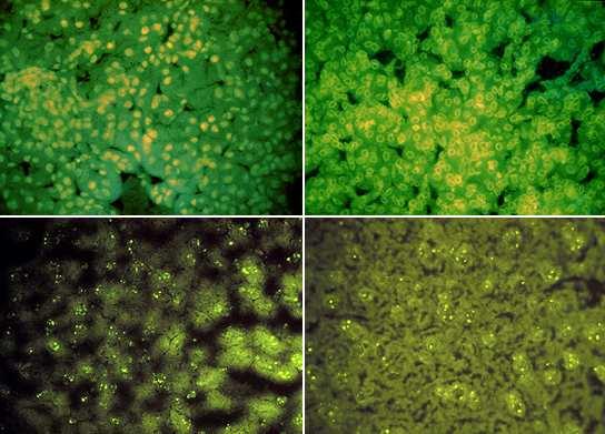 Antinuclear antibodies (ANA) Detected by immunoflourescence Have different patterns Diffuse Speckled Centromere Nucleolar Have