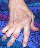 physiciandiagnosed rheumatic disease The measures detected interesting differences among rheumatic disease diagnoses suggesting that