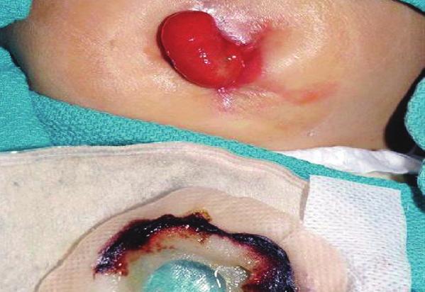 Case Study 1: Infant with Fistula A full term infant was born with gastroschisis involving intestinal necrosis. At two months old, the newborn developed a small bowel obstruction.