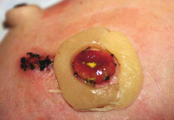 Paste was applied lateral to the stoma since leakage never occurred in ths area, therefore, an extended wear barrier was not required there (Photo 3).