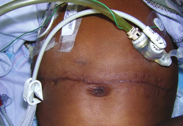 This pouching process was utilized until patient was surgically closed two months later (Photo 8).