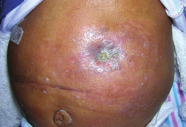 Pouch adherence was maintained for four days. The patient s skin improved greatly (Photo 6).