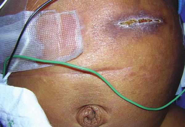 Case 5: Photo 7 The initial plan of care included crusting the peristomal skin with ostomy powder and an alcohol free skin protectant.