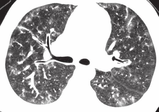 Enlargement of pulmonary arteries from pulmonary hypertension is visible in A but is better shown in Figure 7.