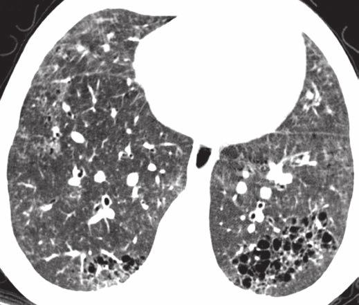 3 7-year-old girl with systemic sclerosis and pulmonary fibrosis.