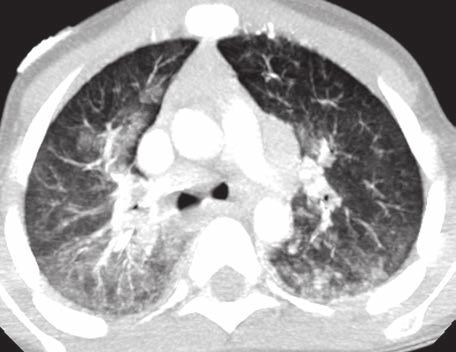 or atelectasis. B A B Fig. 7 5-year-old boy with pulmonary hemorrhage obscuring early fibrosis.