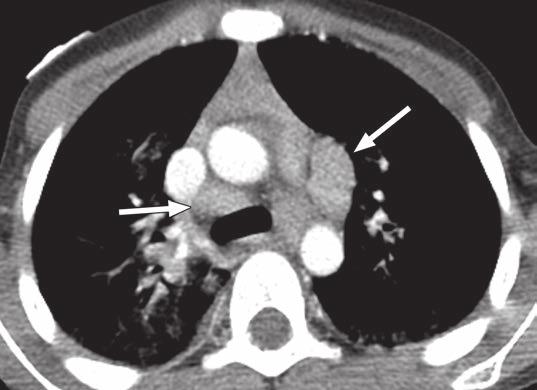 C and D, CT images in soft-tissue windows show extensive mediastinal (arrows, C),