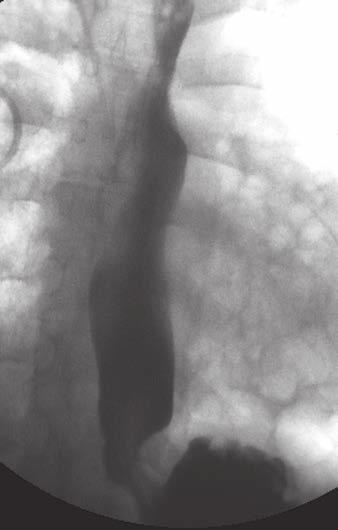 Valeur et al. A Fig. 10 16-year-old girl with systemic sclerosis and esophageal involvement.