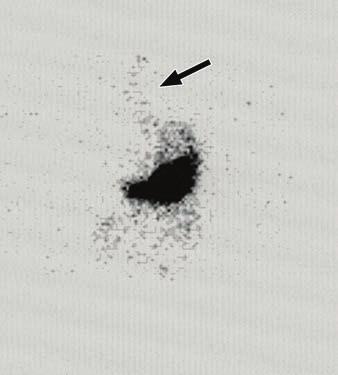 B and C, Planar images obtained at two different time points from 99m Tc-labelled sulfur colloid examination reveal that tracer (arrows)