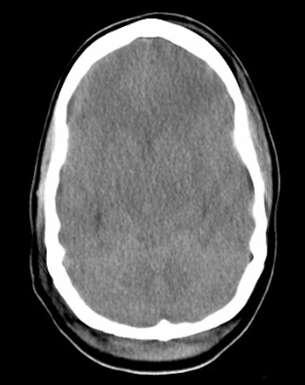 Petient with 58 years old, He was received in the emergency room 1 hour after head trauma, 7 points in GCS, initial CT scan is showed below.