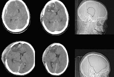A 30 year old patient operated on with intracranial