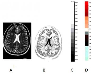 Figure 3 Table 2 A: T2 weighted image B: RI mapping of brain C: RI shade generation D: False color shade. T2 VALUE AND RI RI= - (0.0003 X T2) + 1.3338.