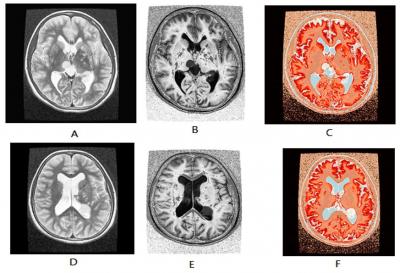 DISCUSSION: Similarly, mass like plaques shown in Figure 7 and 8 suspecting MS in MRI were confirmed by RI and color coded map in the DICOM editor.