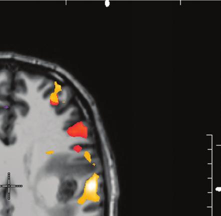 Invivo is leading the way with DynaSuite Neuro, providing analysis of MRI studies for perfusion, diff usion, functional imaging and volumetrics.