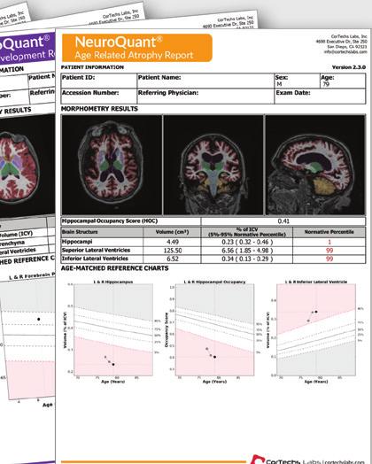 Hippocampal Asymmetry - benefi cial in the assessment of temporal lobe epilepsy and unilateral degenerative conditions,