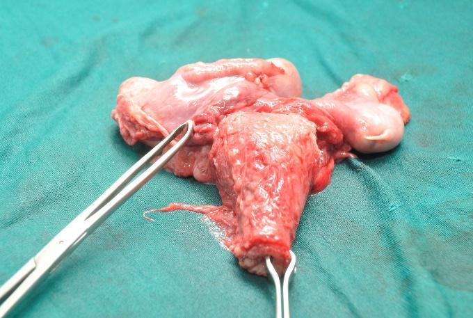 Intraoperatively, mullerian remnants consisting of an infantile uterus and fallopian tubes are usually found. Familiarity with PMDS is necessary to diagnose the condition.