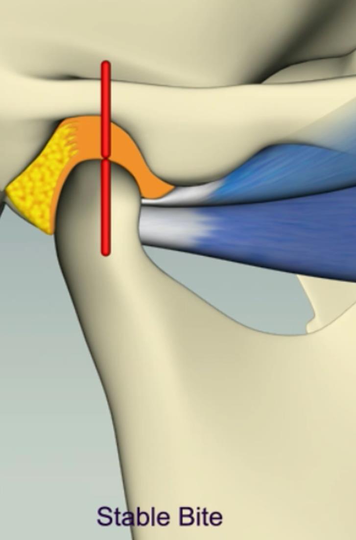 Lower Compartment Condyle with articular disc Disc bound to condyle by