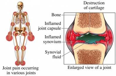 Rheumatoid arthritis (RA) u Chronic, systemic, autoimmune and inflammatory disorder u Joint inflammation, erosive properties, symmetric joint