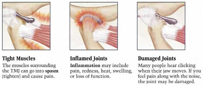 Localized osteoarthritis u Clinical features: arthralgia, crepitus u Often presents unilaterally u Imaging findings: degenerative joint changes u