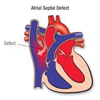 Figure 2: Atrial Septal Defect. Cross-sectional view of a heart with an Atrial Septal Defect.