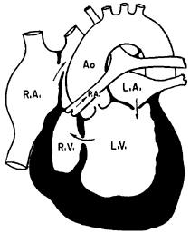 Management of Right Heart Inlet Obstruction Ductal-dependent until