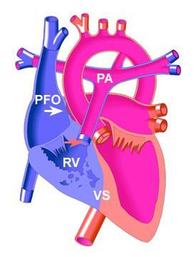 Right Heart Outflow Obstruction