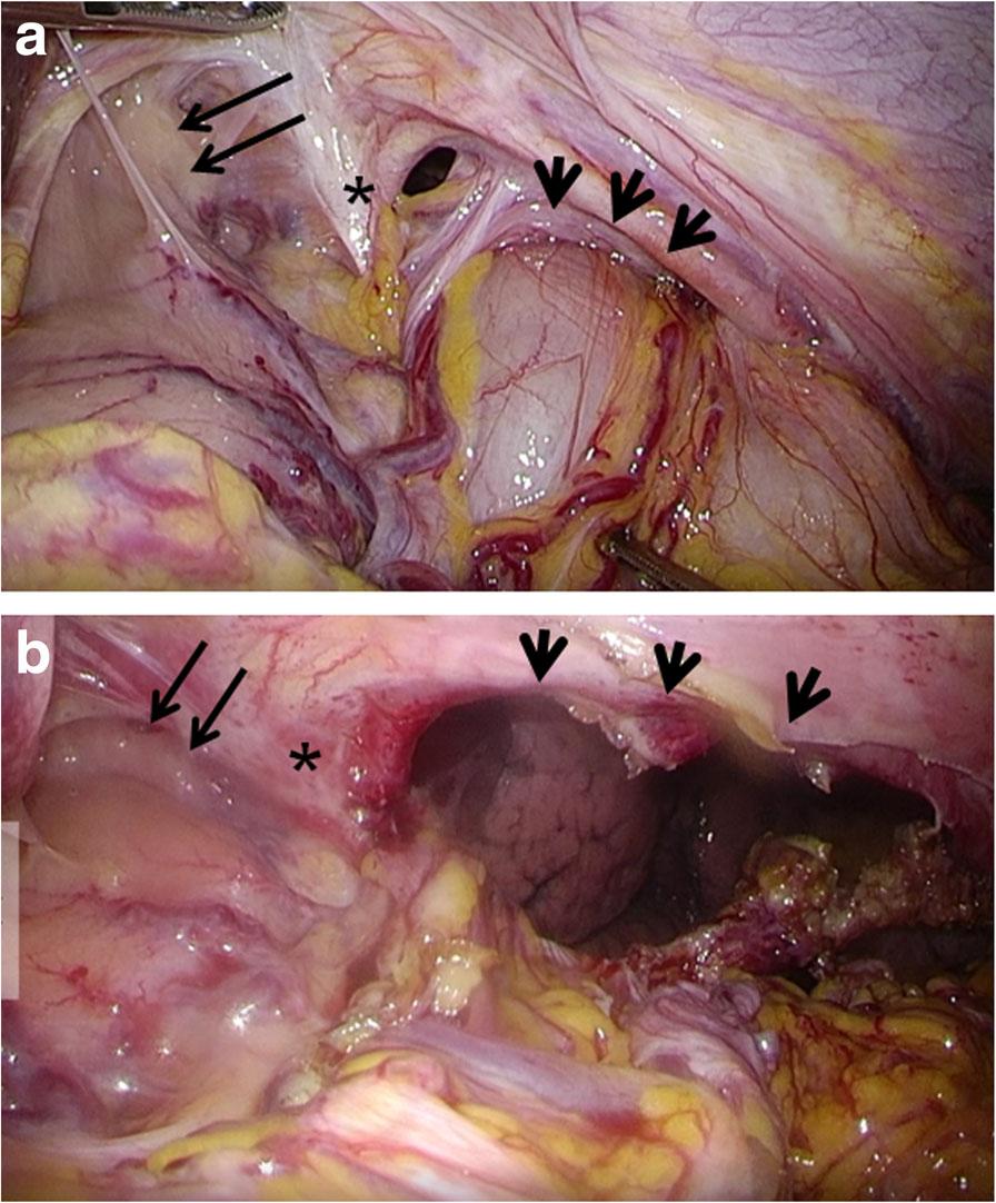 Akiyama et al. Surgical Case Reports (2017) 3:91 Page 3 of 5 Fig. 3 Intraoperative findings of parahiatal hernia.