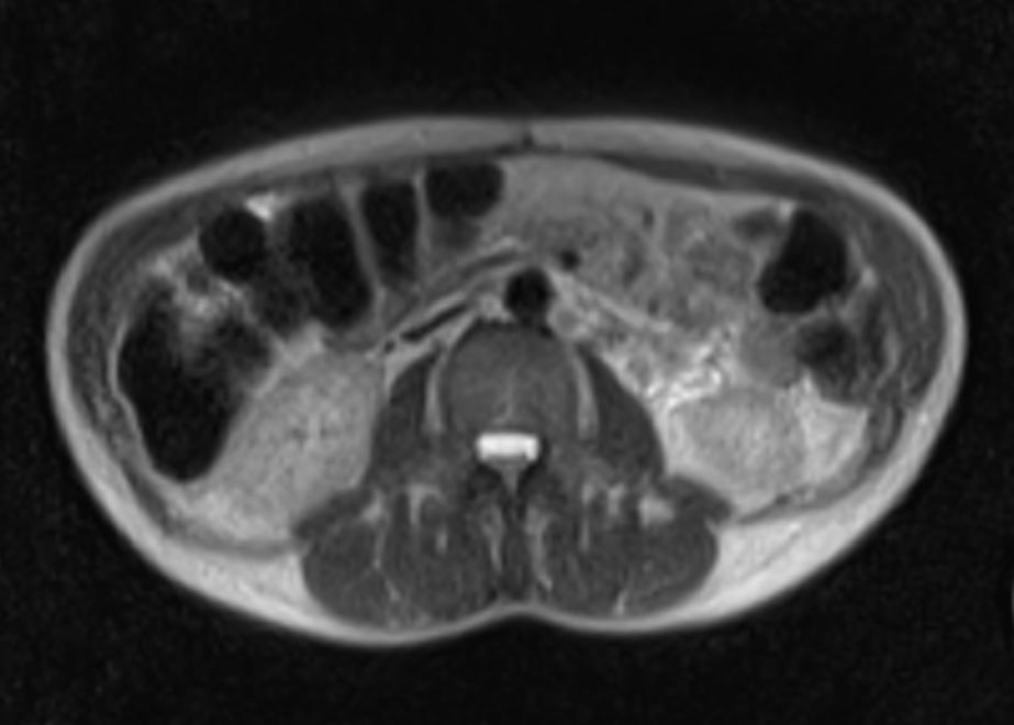 A 39 years old woman with mild lung disease and a large abdominal