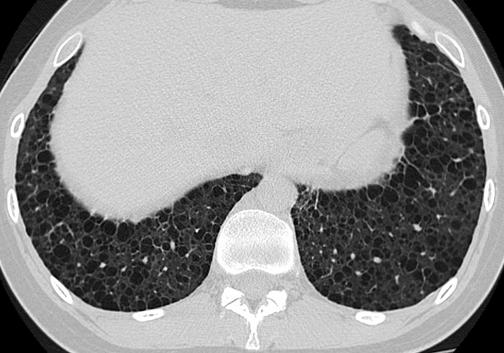 lung cysts distributed