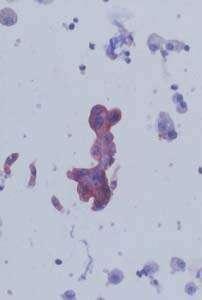 pneumocytes in