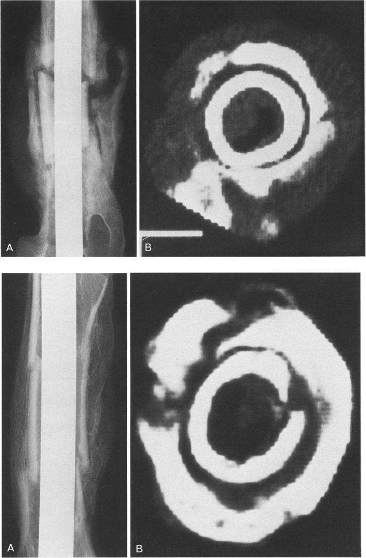 E.M. Braunstein et al. : CT and plain radiography in experimental fracture healing 29 Fig. 3A, B. Twelve weeks A Plain radiographs show organized callus bridging the osteotomy sites.
