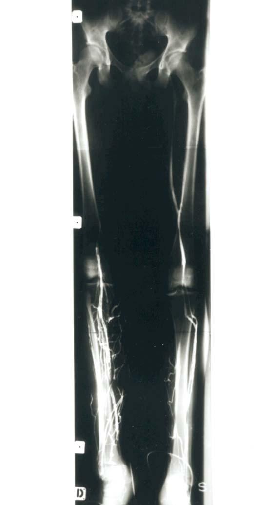 Pain in the right leg Lasting one month MC/ Male 18 yrs of age Proximal DVT LA (drvvt) + acl