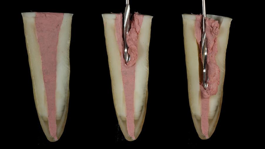 2nd phase: Partial clearing of the root canal and post test Removal of gutta percha from the inside of the canal is performed with Largo burs, followed by the bur provided by the manufacturer that