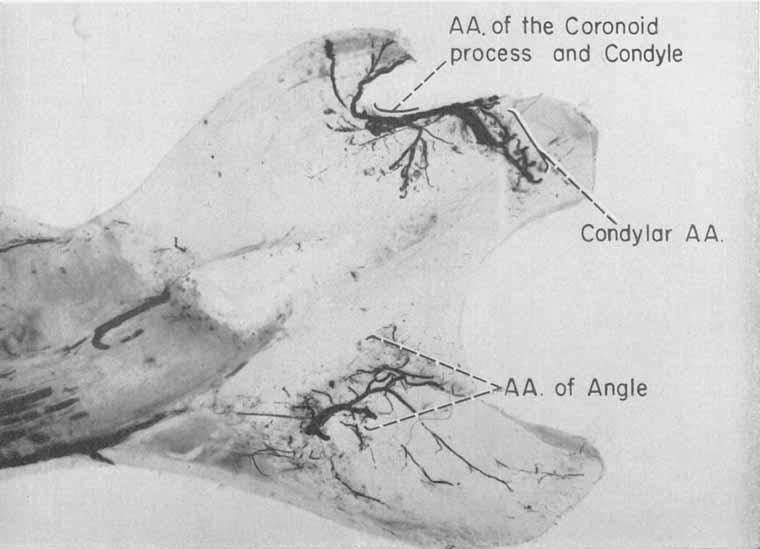 2 An arterial bridge linking the coronoid and condylar processes.