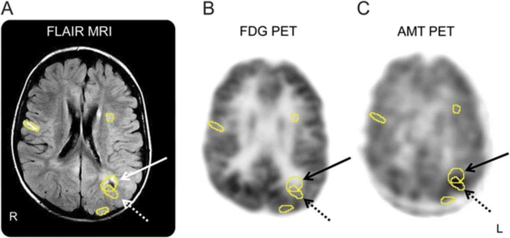 FLAIR MRI (A), FDG-PET (B), and AMT-PET (C) scans in a 4-year-old boy with TSC2 mutation, multiple tubers, intractable seizures, and nonlocalizing scalp EEG.
