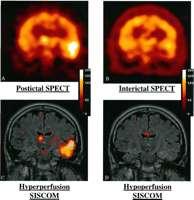 Temporal lobe Focus: ECD SPECT CBF Injection 12