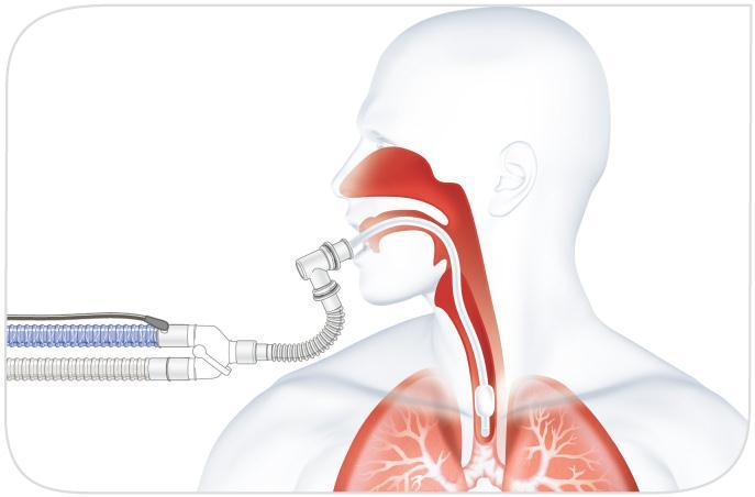 Respiratory Humidification Normal airway humidification is bypassed or compromised during ventilation or O 2 therapy Mucociliary transport