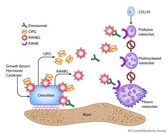 Denosumab Denosumab Human monoclonal antibody binds RANKL Inhibits RANKL activity Reduces osteoclastic differentiation, survival, activity Treatment has been