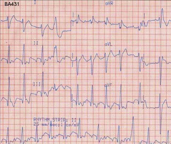 resuscitated PE:BP 110/70 with HR of 77