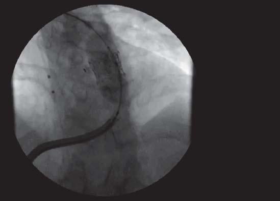 Porcine pericardial valve on nitinol