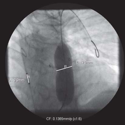 covered self expanding stent RVOT