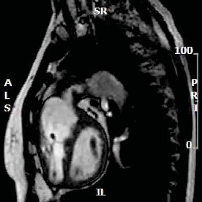 Cardiac MRI Phase Contrast LVEDV 50cc/m2