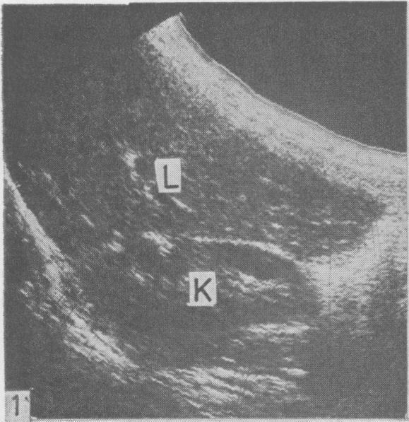 Prospective study of liver ultrasound 131 Fig. 1 Normal liver. Longitudinal section through the right lobe of the liver and the kidney. L:liver. K:kidney. Fig. 2 Steatosis. Section similar to Fig. 1. Increased echogenicity as compared with the renal parenchyma with small and tightly packed echo targets.