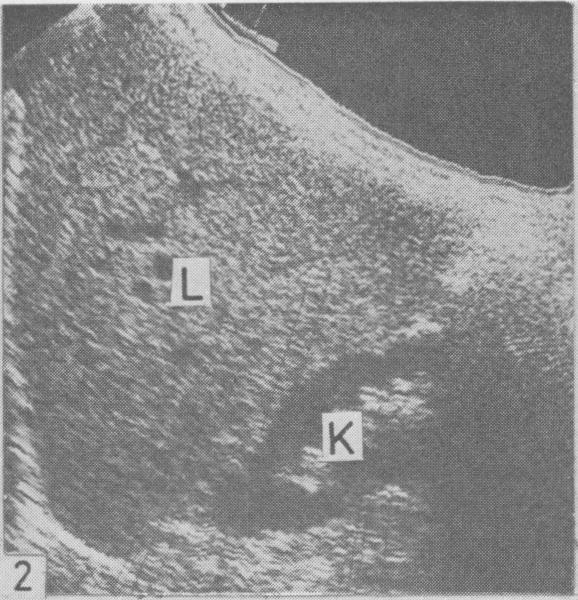 Fig. 5 Posthepatitic (macronodular) cirrhosis. Oblique subcostal scan through the right lobe. Coarse echo targets. Normal overall echogenicity. Normal beam penetration. A :ascites. Fig.