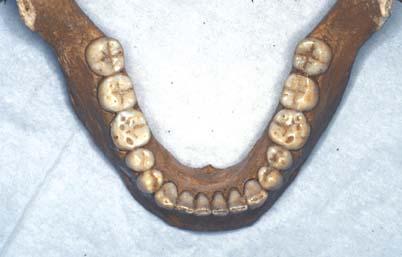 B14 Prehistoric adult mandible