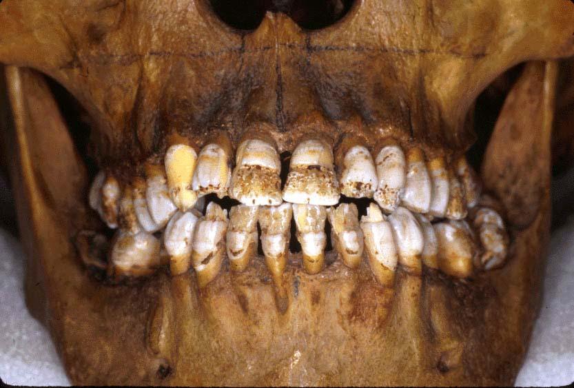 B19 Defective teeth -
