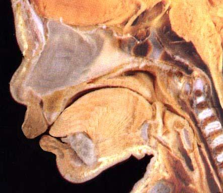 Soft palate Epiglottis B35 Atlas picture demonstrating similar