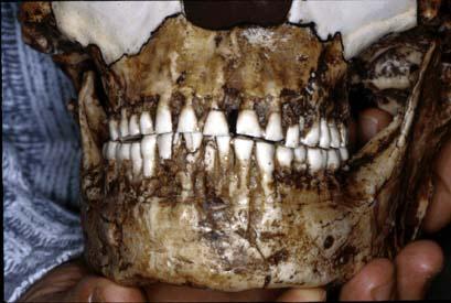 B6 70,000 year old AMUD skull