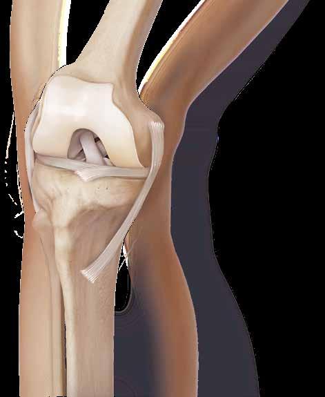 When the cartilage structures of the knee wear out, the underlying bone surfaces are exposed and rub against each other, leading to swelling and pain with activities of daily