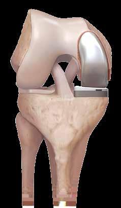 Knee replacement surgery can include either partial knee resurfacing and or total knee replacement.